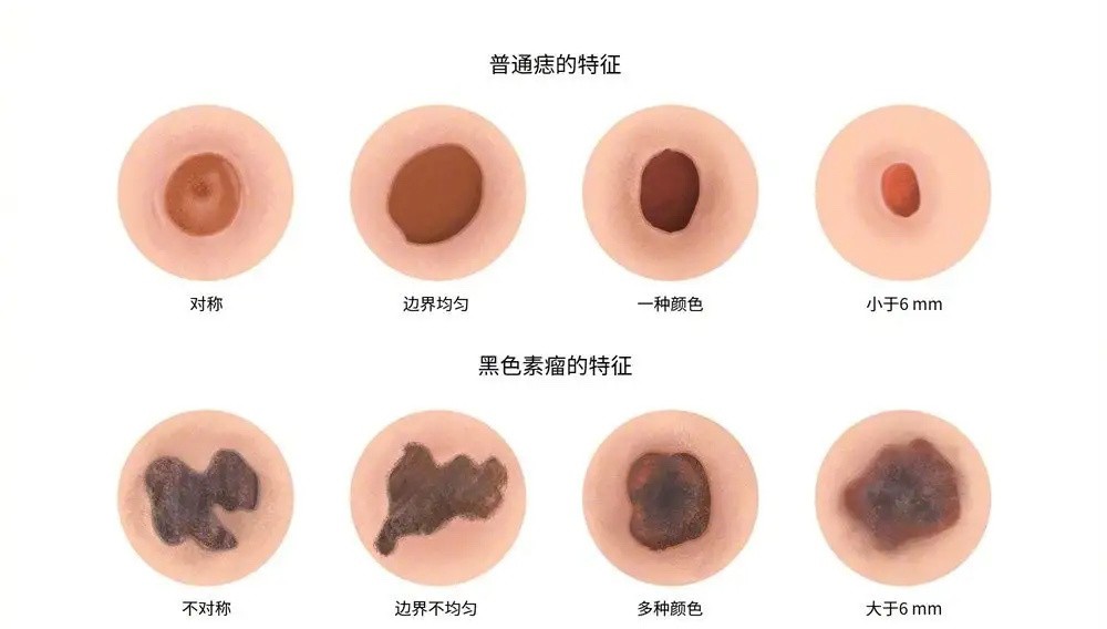 怎样分辨黑色素瘤-黑色素瘤和普通痣的区别介绍